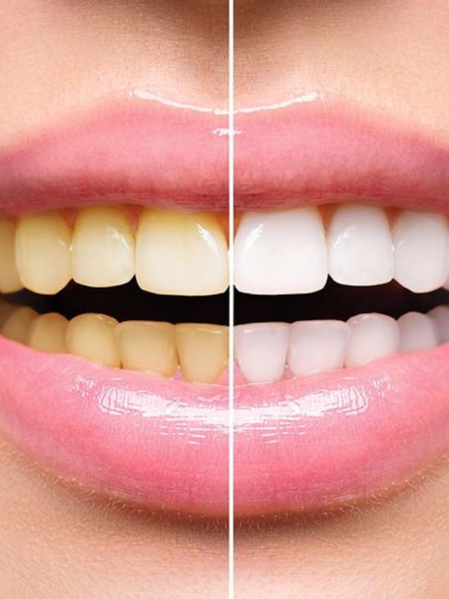 7 Easy Ways To Get Rid Of Yellow Stains On Your Teeth